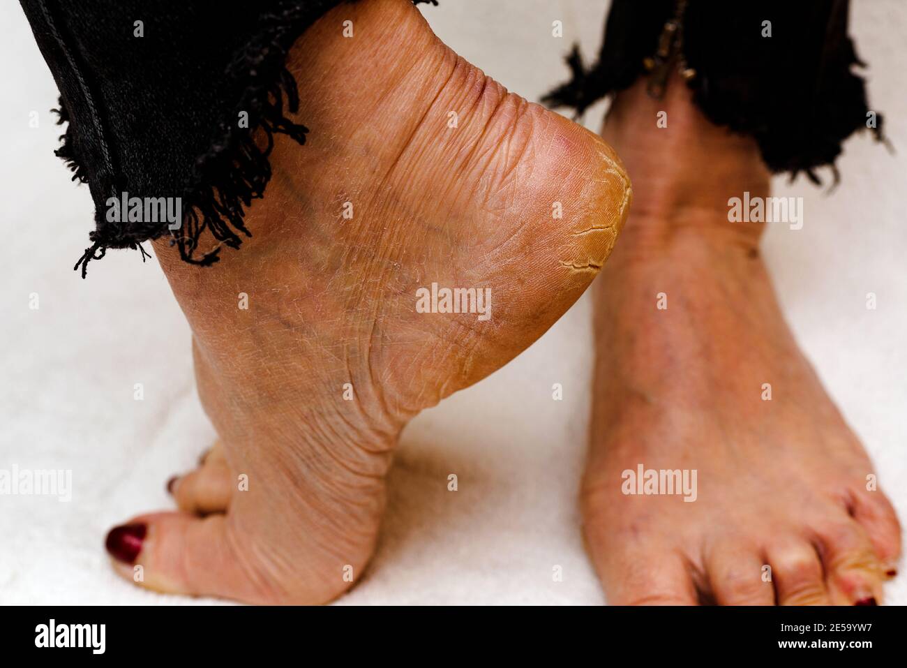 Dry and cracked soles of feet. Womans feet with dry heels cracked skin.White soft background Stock Photo Alamy