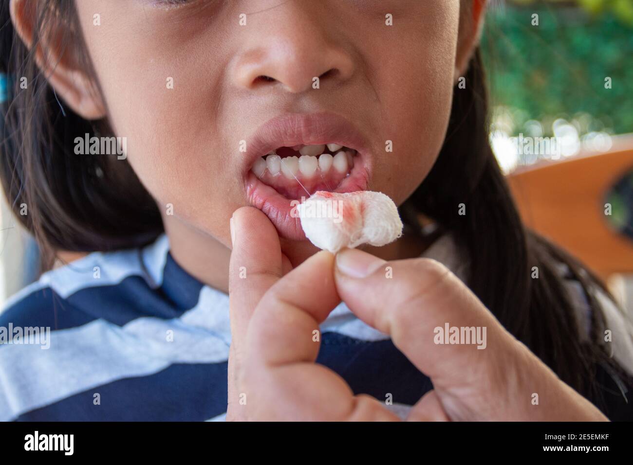 Postdental girl at dental clinic with gauze at the mouth, Sore and sad