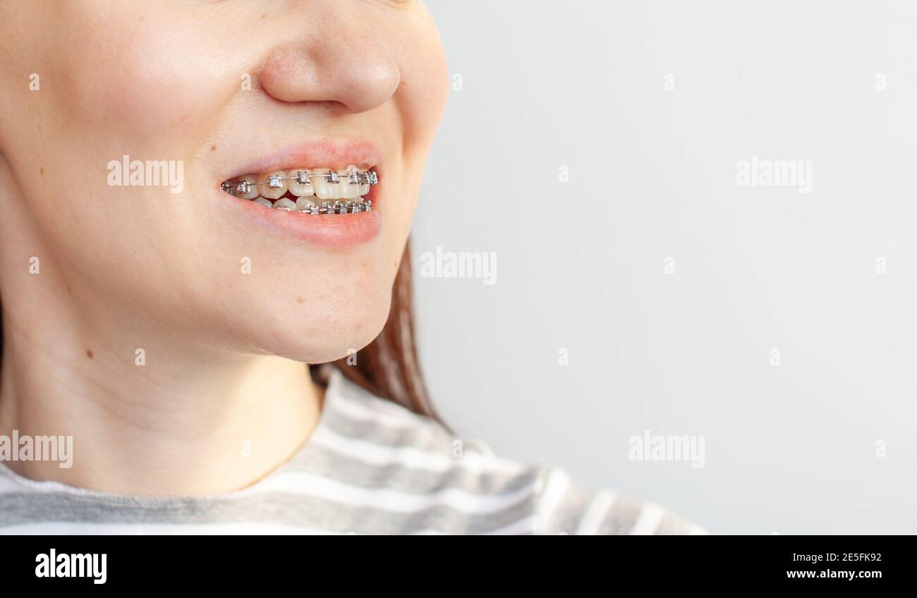 what color braces make teeth whiter