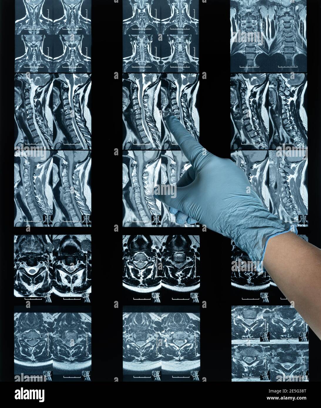 Magnetic resonance imaging neck disc protrusion laboratory film and hand Stock Photo