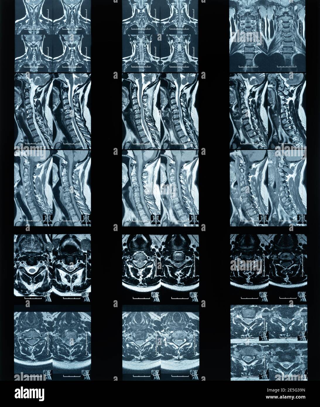 Magnetic resonance imaging neck disc protrusion laboratory film Stock Photo