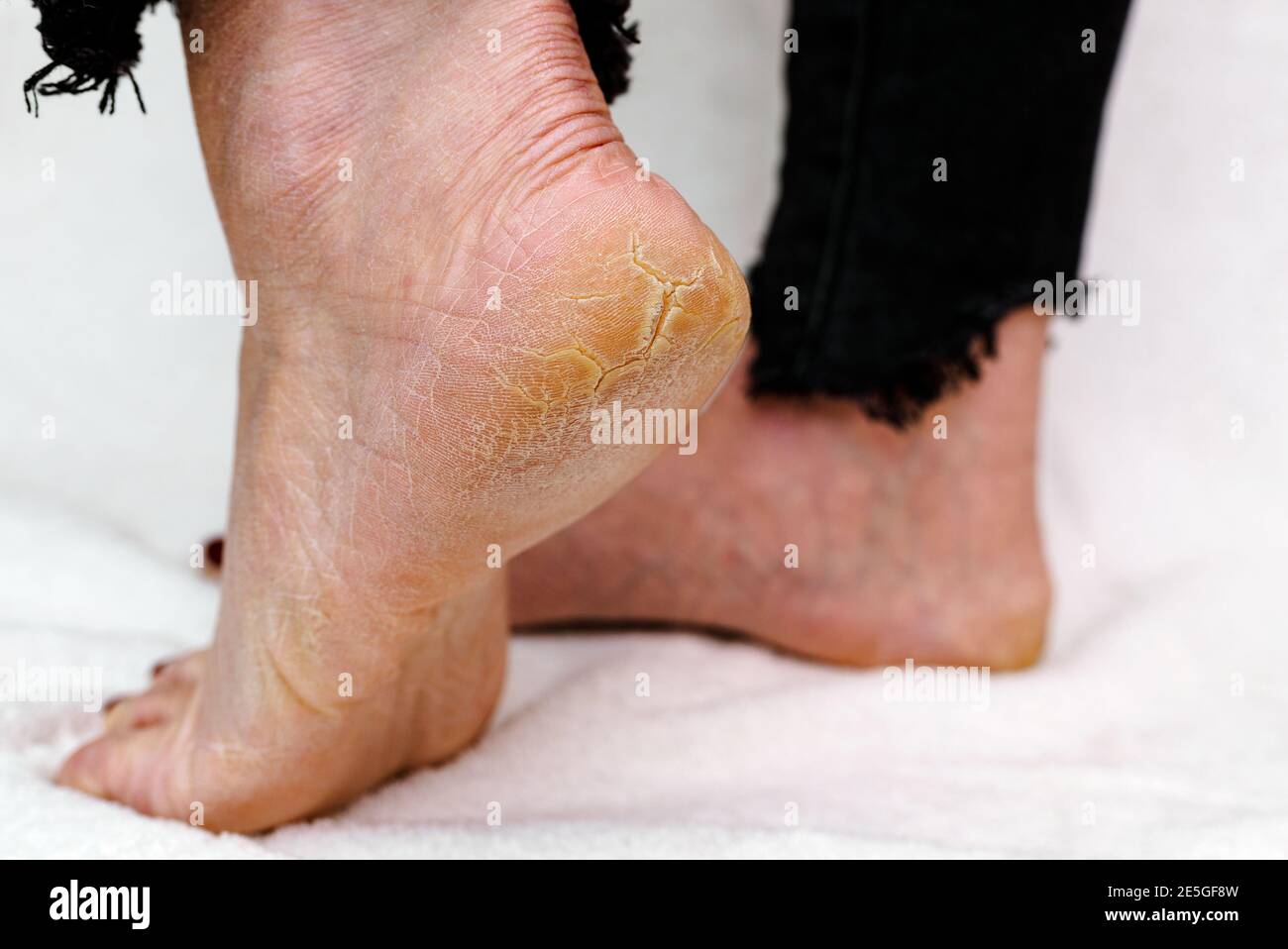 Dry And Cracked Soles Of Feet Womans Feet With Dry Heels Cracked Skinwhite Soft Background 