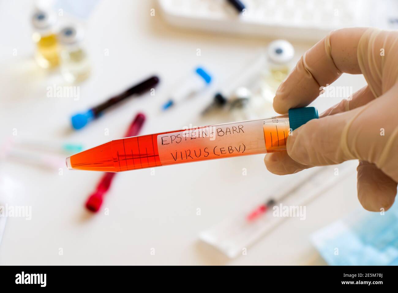 Mononucleosis and Epstein-barr virus blood test sample in lab on the ...