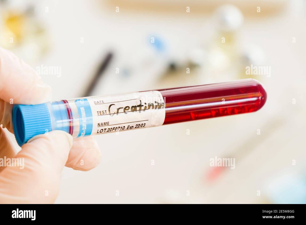 Creatinine blood test tube sample in doctors hand holding in laboratory