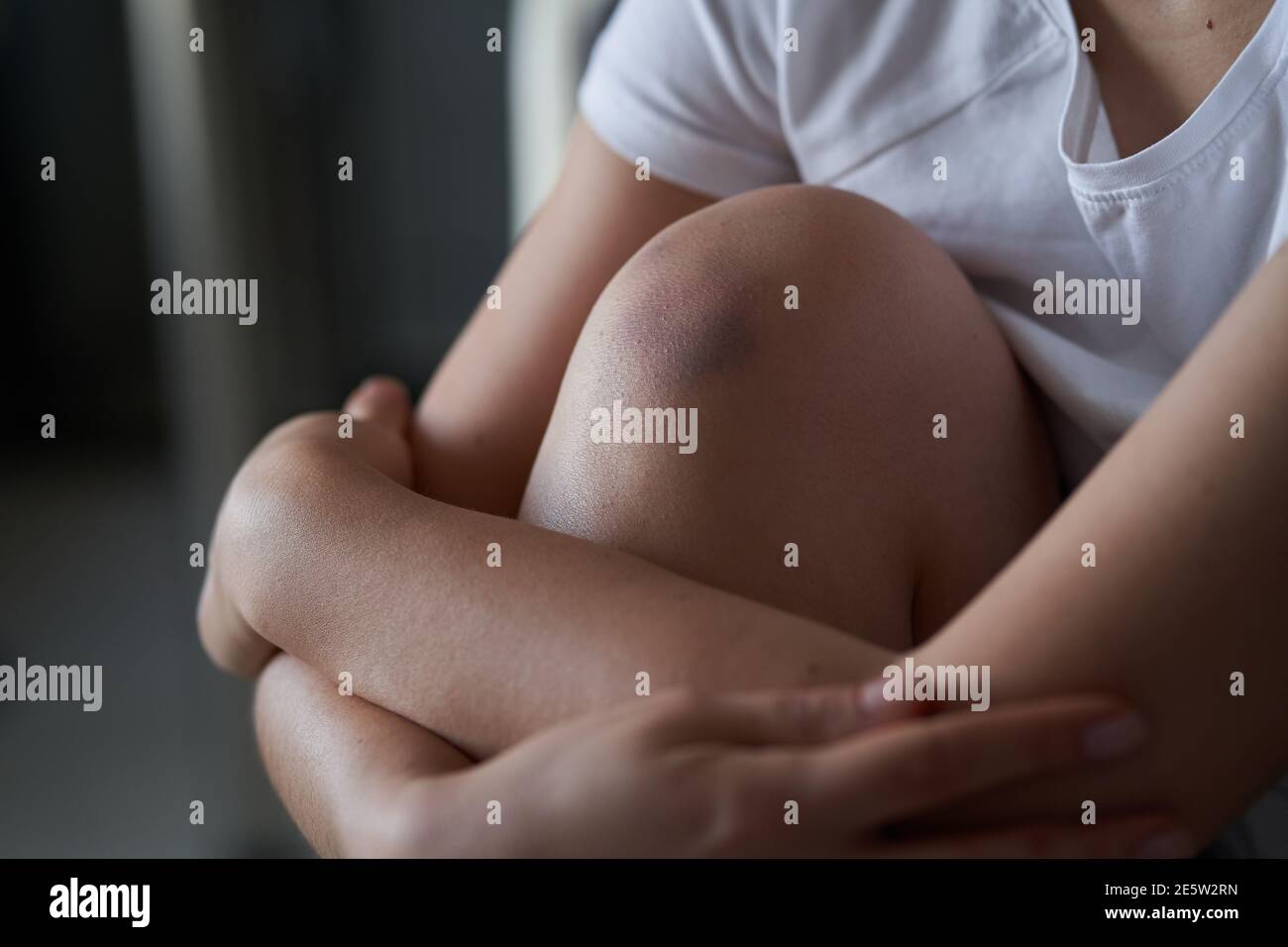 Close-up of a person massaging an injured knee joint. Bruise on the knee. Leg pain. Stock Photo