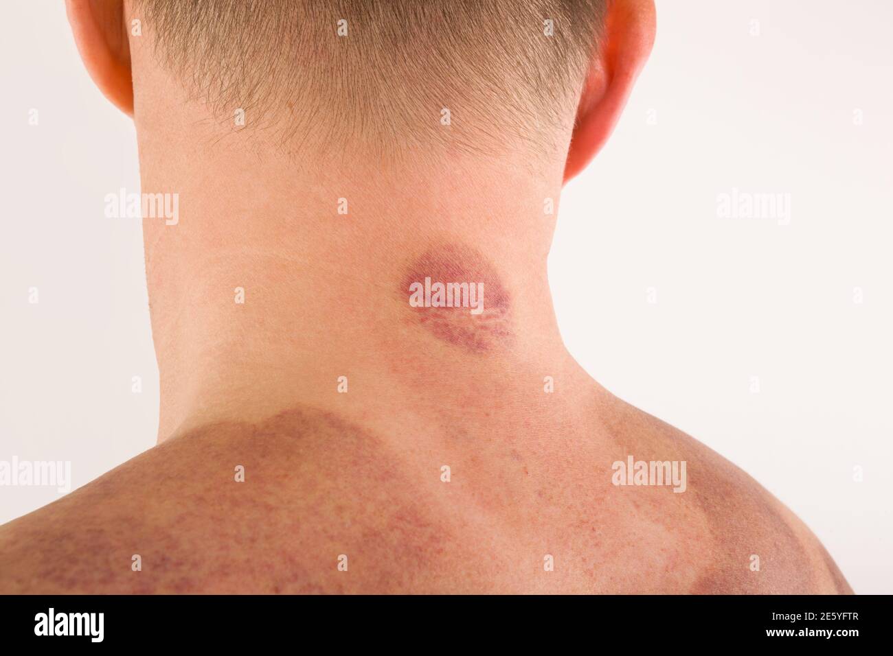 Cupping therapy marks on handsome man's back. Massage and wellness concept  Stock Photo - Alamy