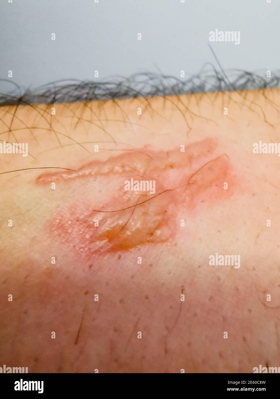 Image of an ugly burn scar on the forearm of a man Stock Photo