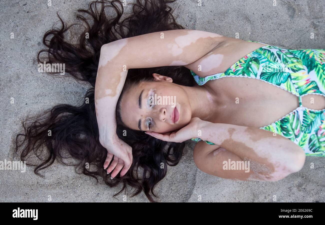 Beautiful brunette mature Woman with vitiligo pigment spot disease and long  black hair lies thoughtfully worried in the sand in bathing suit swimwear  Stock Photo - Alamy