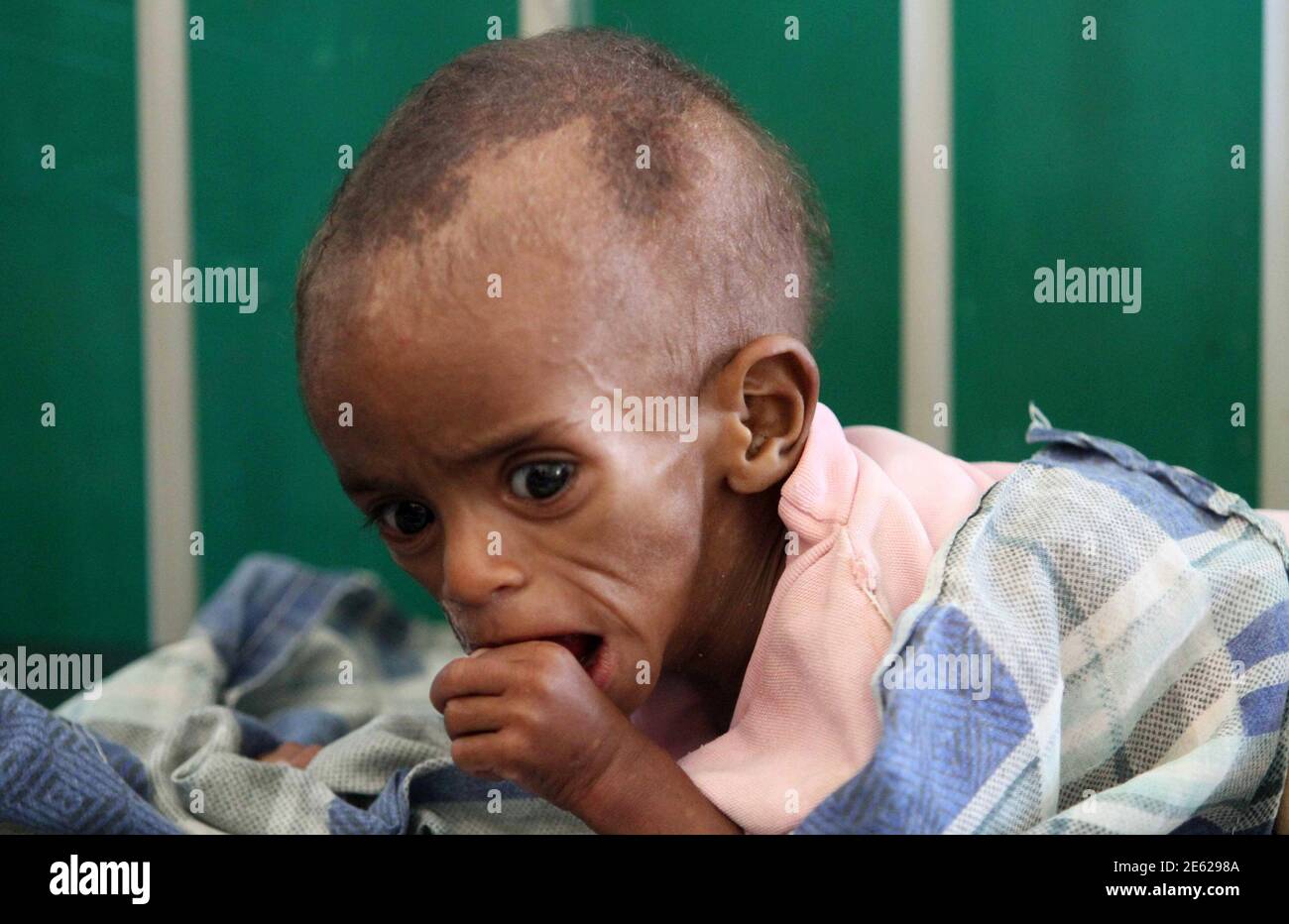 A malnourished Somali child rests inside the paediatric ward at the Banadir hospital in southern Mogadishu, August 3, 2011. The Horn of Africa food crisis shows the need to provide the world's poor with better access to family planning as part of efforts to prevent future tragedies, the head of the United Nations Population Fund (UNFPA) said. REUTERS/Feisal Omar (SOMALIA - Tags: SOCIETY ENVIRONMENT DISASTER) Stock Photo