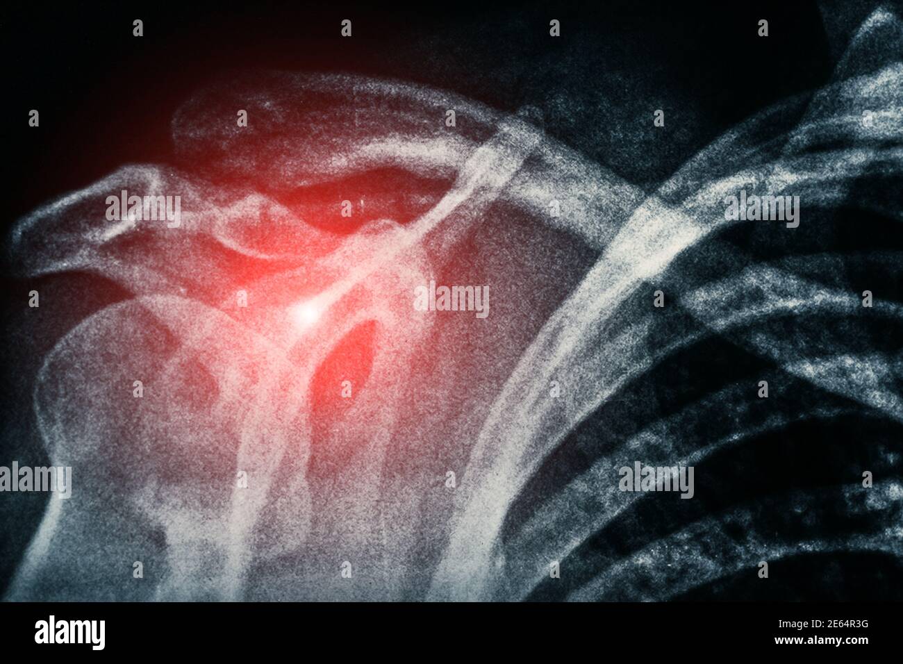 X-ray of shoulder, roentgen picture of human bones of skeleton and red spot as symbol of illness and pain. Stock Photo