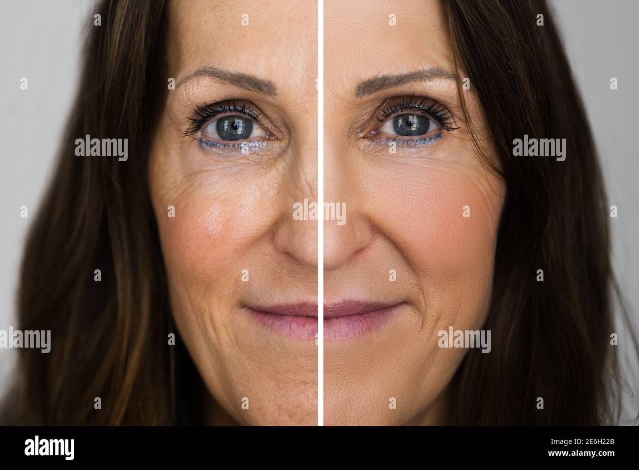 Anti Rejuvenation Wrinkles Lift Before And After Stock Photo