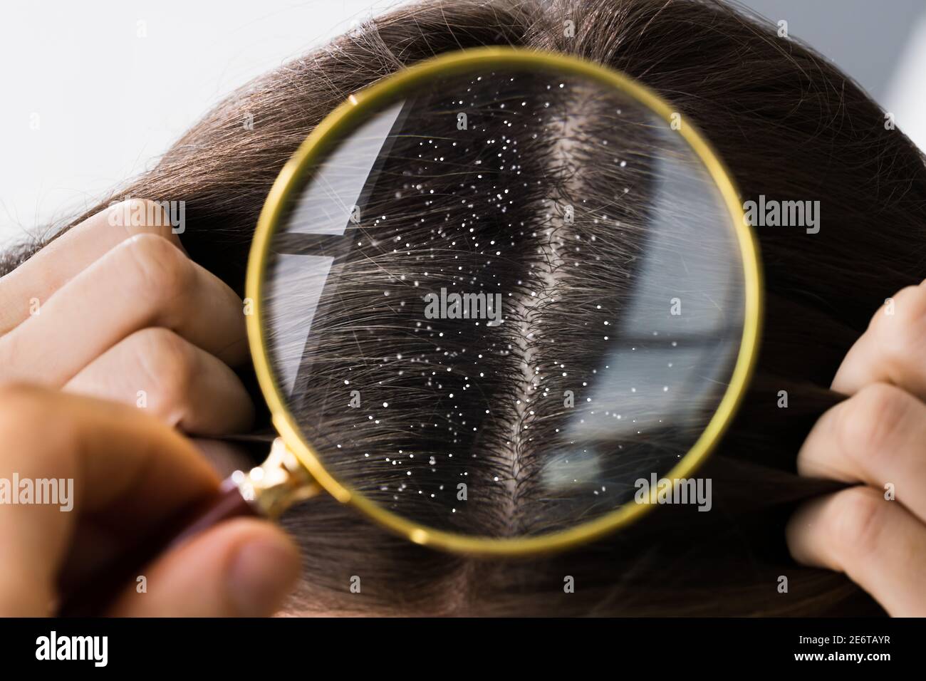 Hair Dandruff And Itchy Scalp Problem Treatment Stock Photo