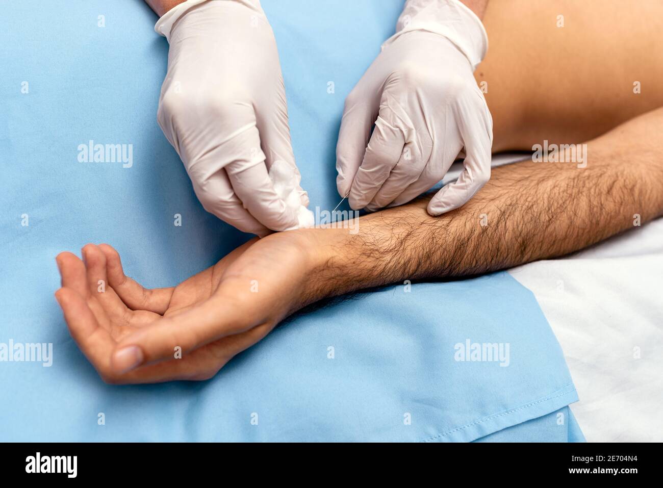 Stock photo of unrecognized worker doing acupuncture procedure to male