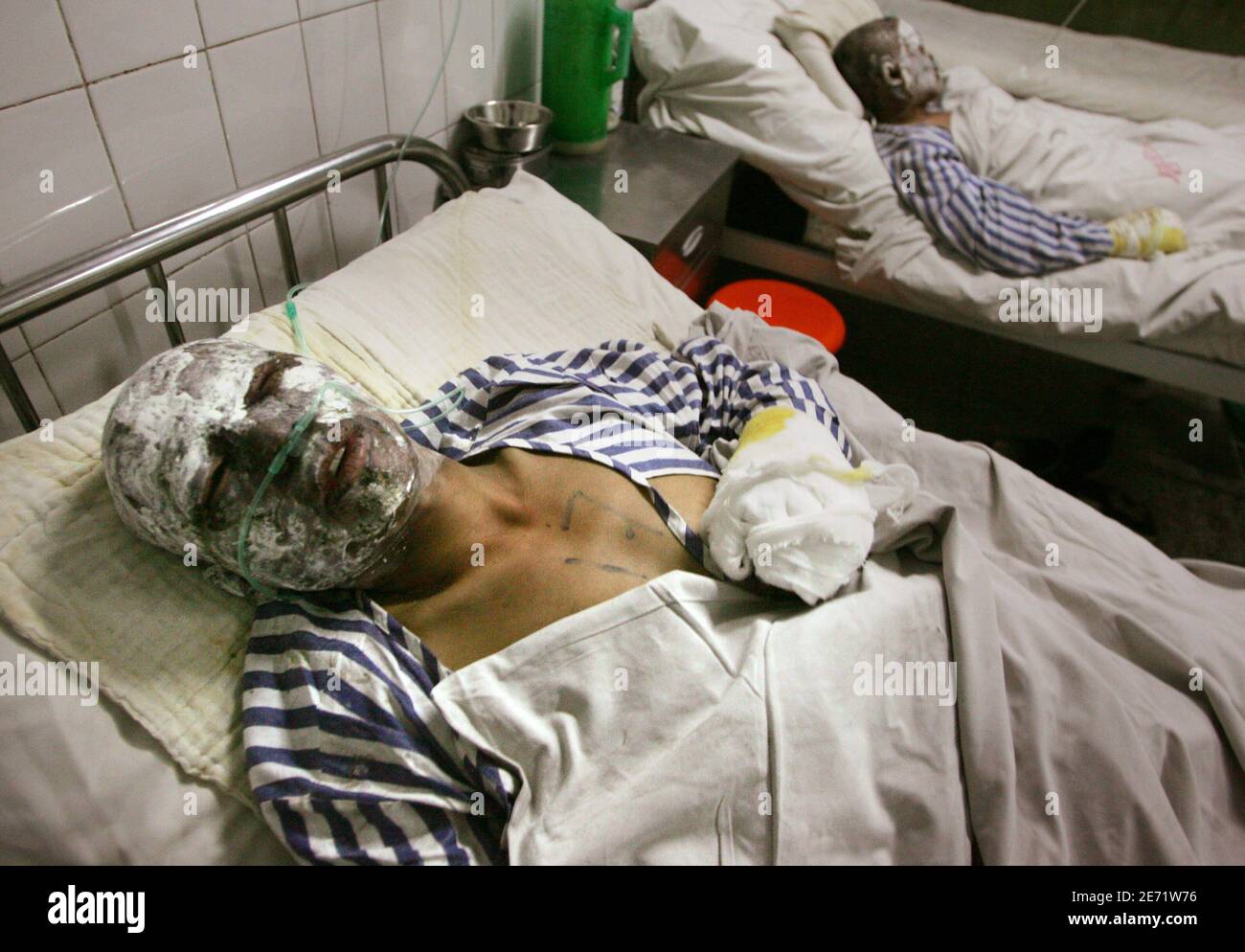 A survivor of a coal mine blast receives medical attention at a hospital after an explosion in Tangshan, China's Hebei province December 8, 2005. A gas explosion at a Chinese coal pit has killed at least 74 miners, state media said on Thursday, notching up another statistic in a grimly predictable series in the world's deadliest mining industry. Stock Photo