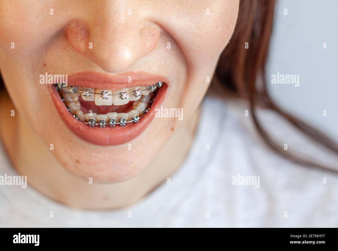 Braces in the smiling mouth of a girl. Closeup photos of teeth and