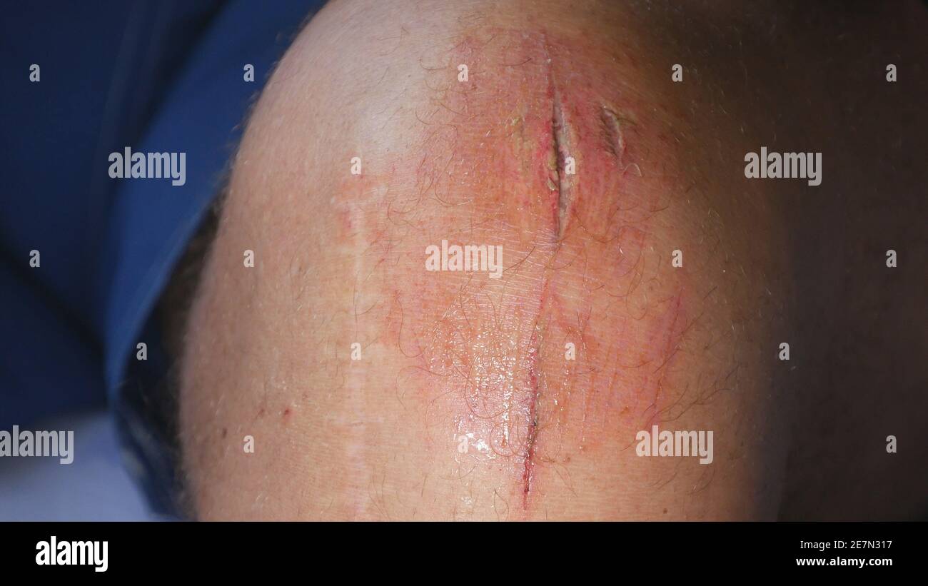 Close Up Image with a Bleeding Wound on the Knee. Medical Treatment at the Emergency Hospital. Stock Photo
