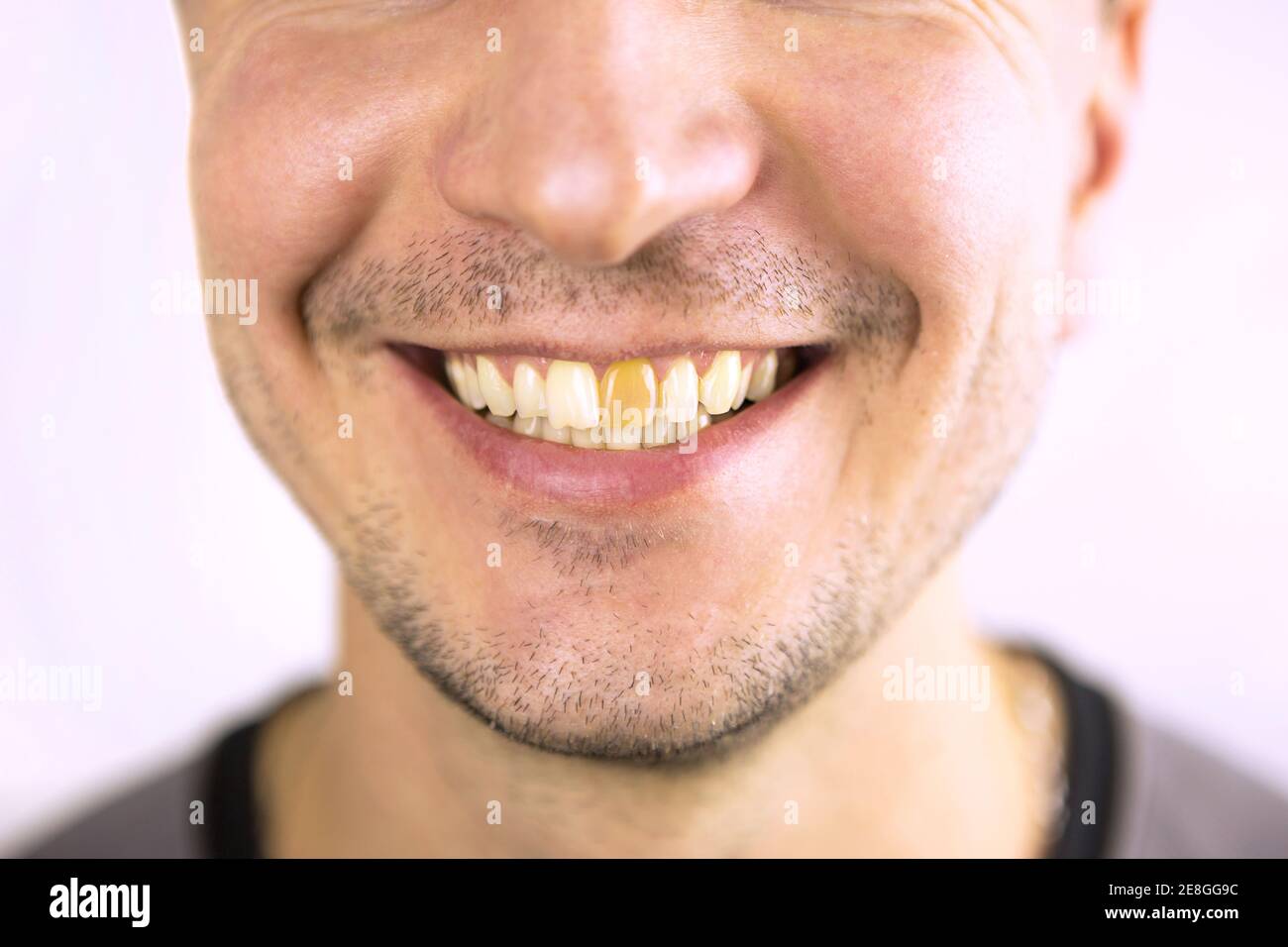 Yellow damaged tooth of a smiling Caucasian man in closeup. Focus on