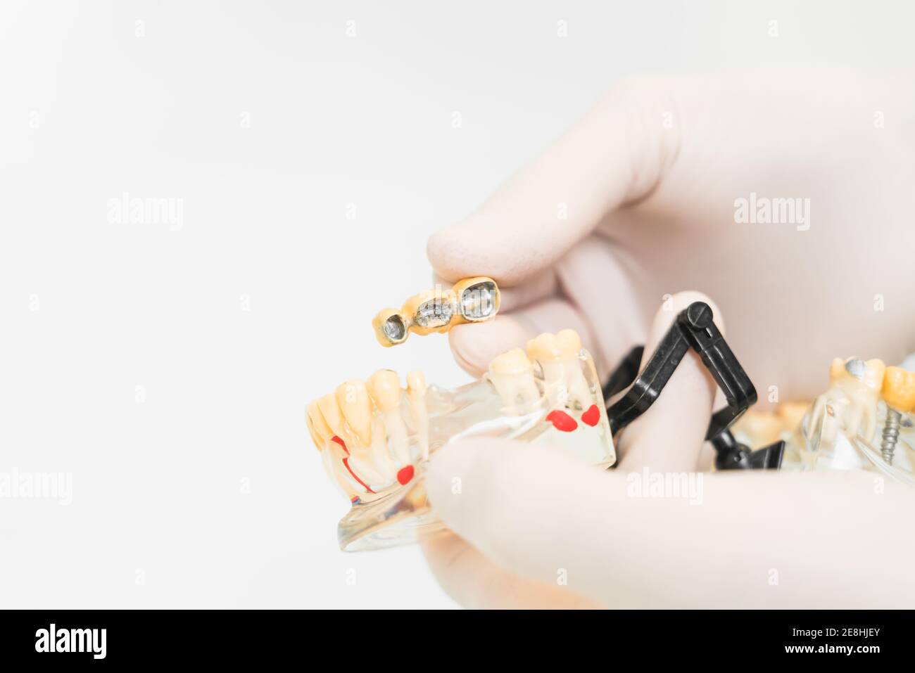 Crop anonymous dentist in protective latex gloves showing dental prosthetics with implants wax up in modern clinic Stock Photo