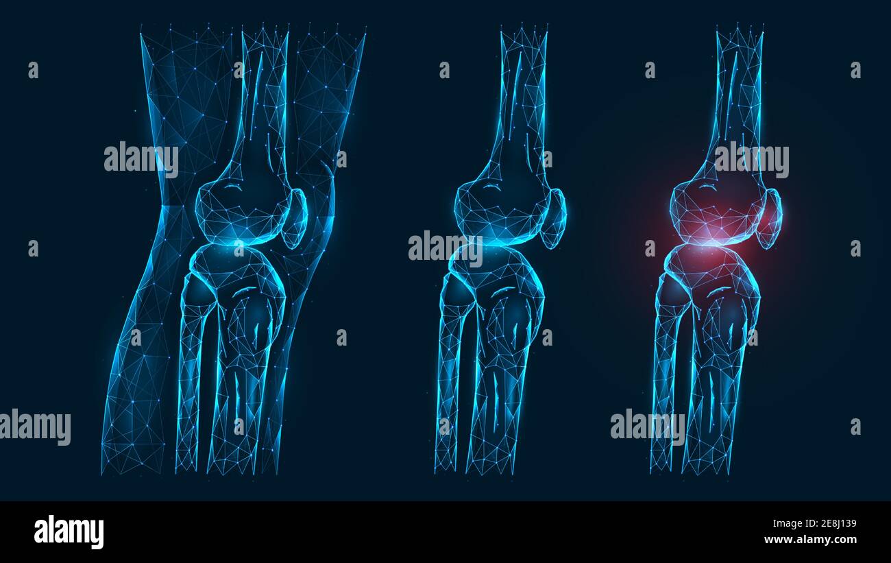 Polygonal vector illustration thigh and knee joint side view. Disease, pain, and inflammation of the knee joint. Low poly model of a healthy and injur Stock Vector