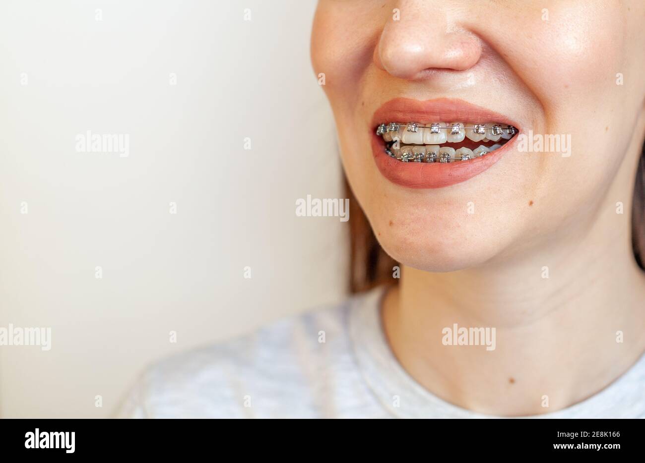 Braces in the smiling mouth of a girl. Closeup photos of teeth and