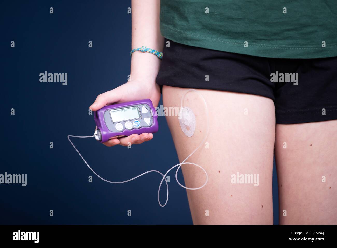 Close up view of a diabetic child with an insulin pump.Child diabetes concept Stock Photo Alamy