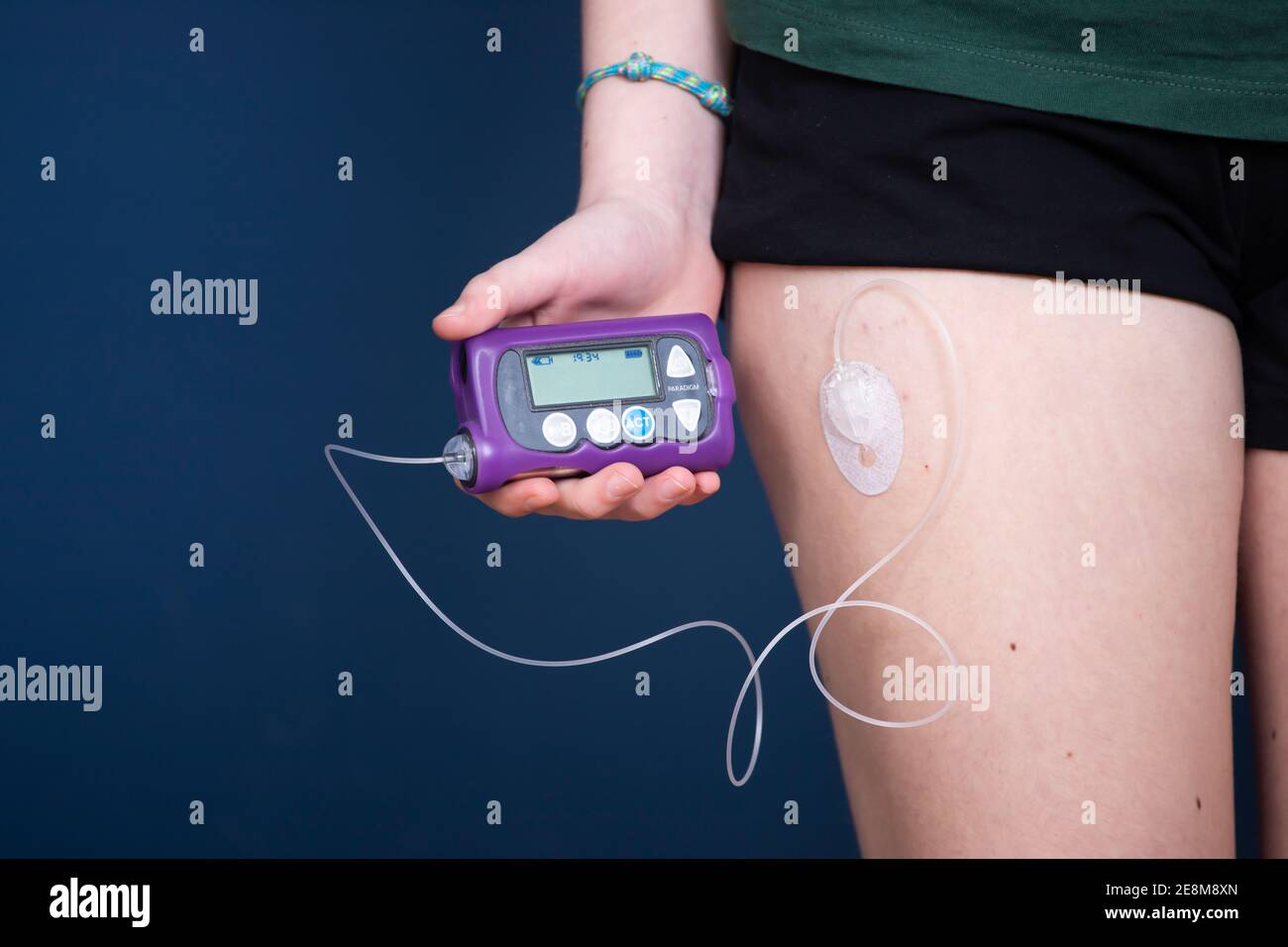 Close up view of a diabetic child with an insulin pump.Child diabetes