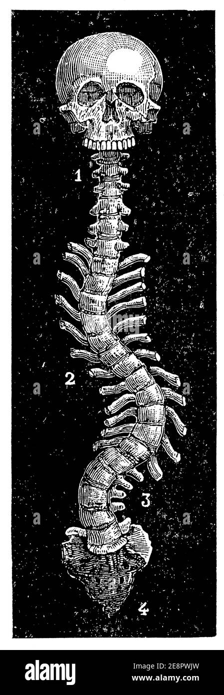 Scoliotic curved spine. Illustration of the 19th century. Germany. White background. Stock Photo