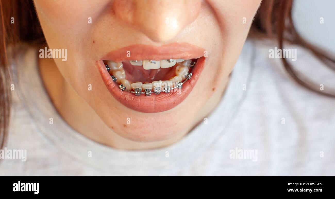 Braces in the smiling mouth of a girl. Closeup photos of teeth and