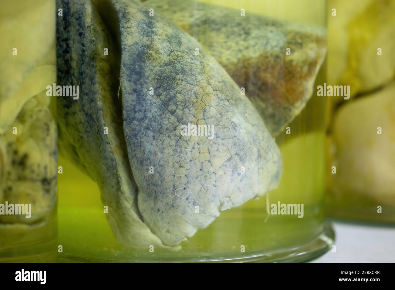 Lungs with cancerous changes floating inside jar with formaldehyde in morgue Stock Photo