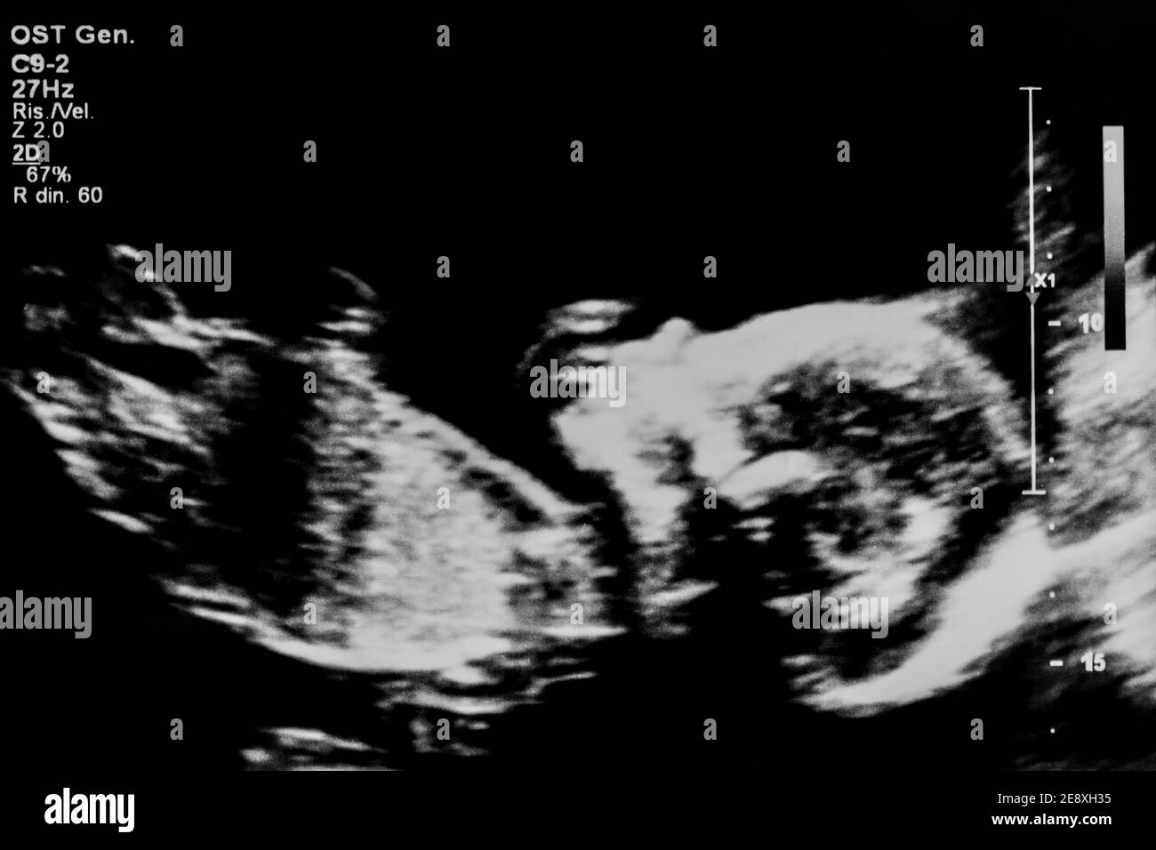 Ultrasound picture of a baby at 20 weeks in pregancy Stock Photo