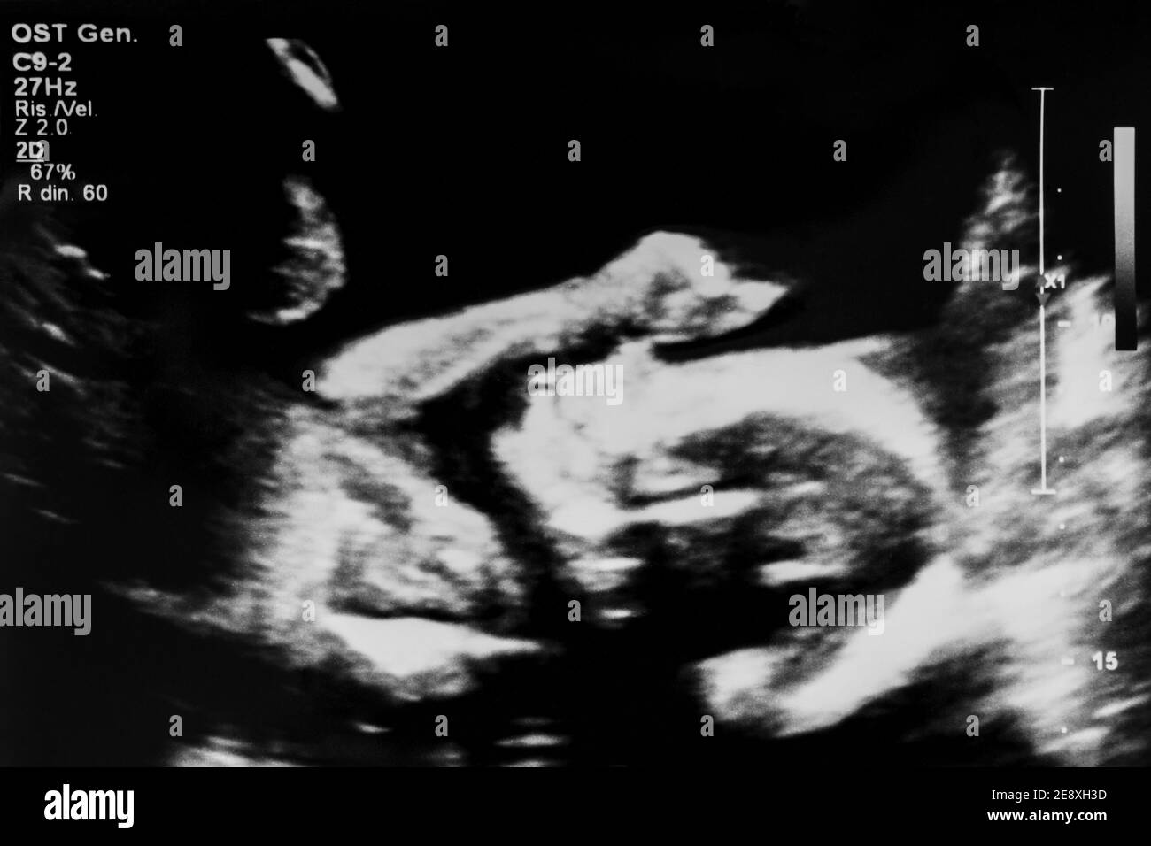 Ultrasound picture of a baby at 20 weeks in pregancy Stock Photo