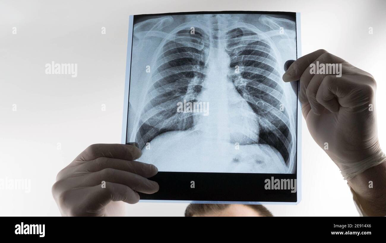 Human lung xray analysis, doctor examines lung disease. Pneumonia