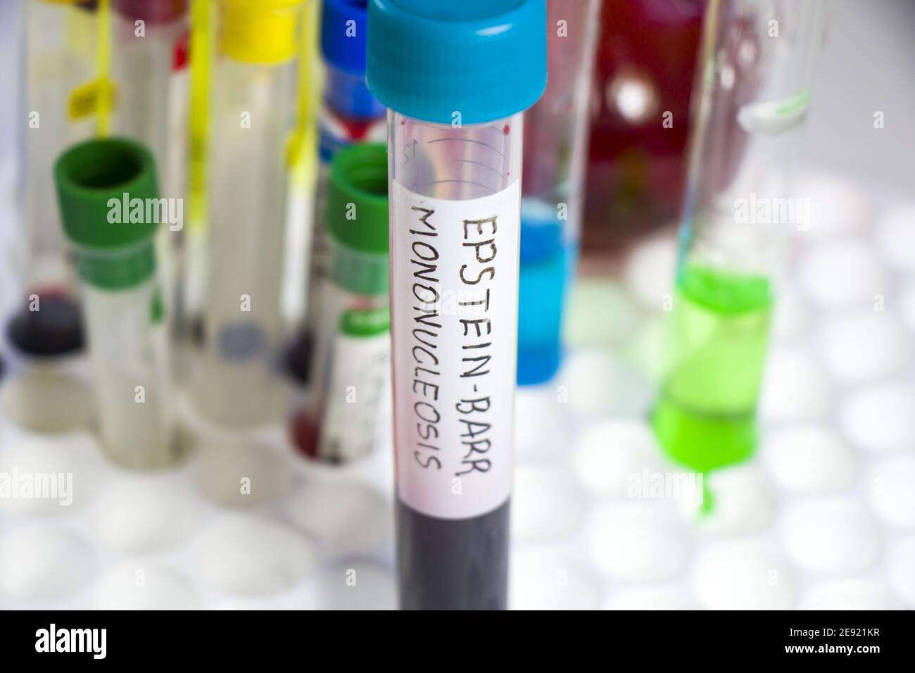 Closeup shot of Epsteinbarr and Mononucleosis virus blood specimen on