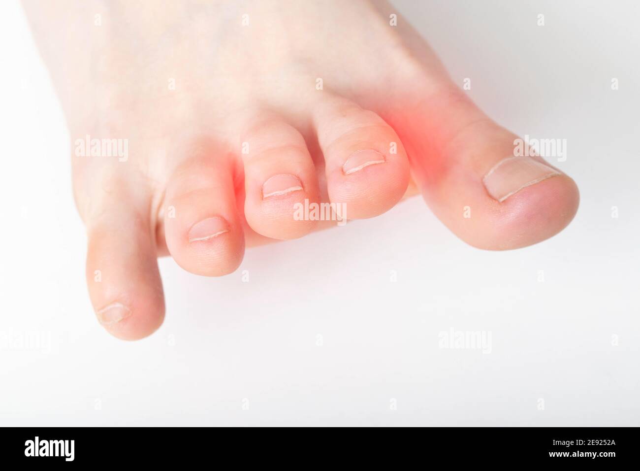 A crooked and stiff toe on a white background. Interdigital neuralgia, macro, copy space for text. Rheumatism Stock Photo