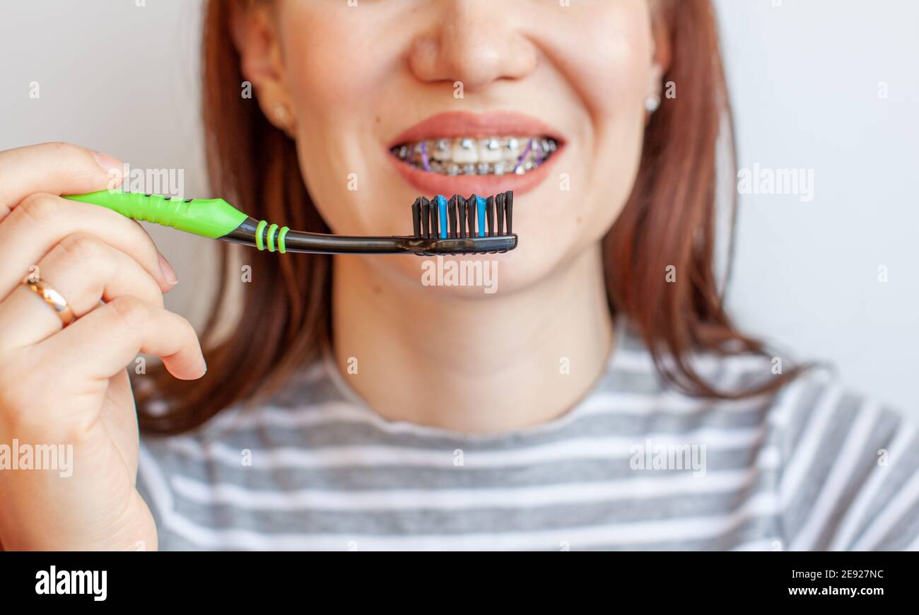 Braces in the smiling mouth of a girl. Closeup photos of teeth and