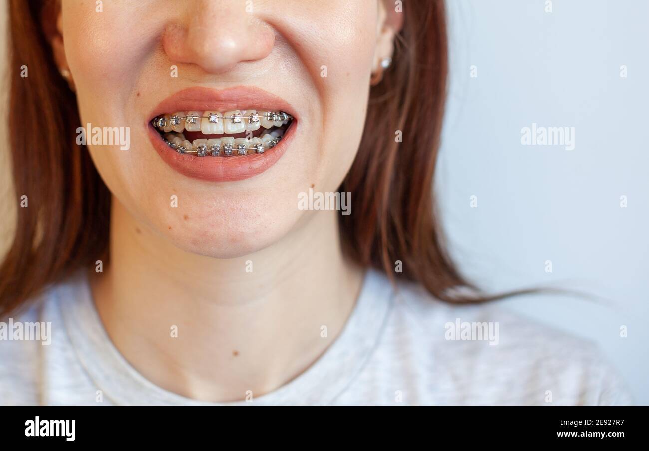 Braces in the smiling mouth of a girl. Closeup photos of teeth and
