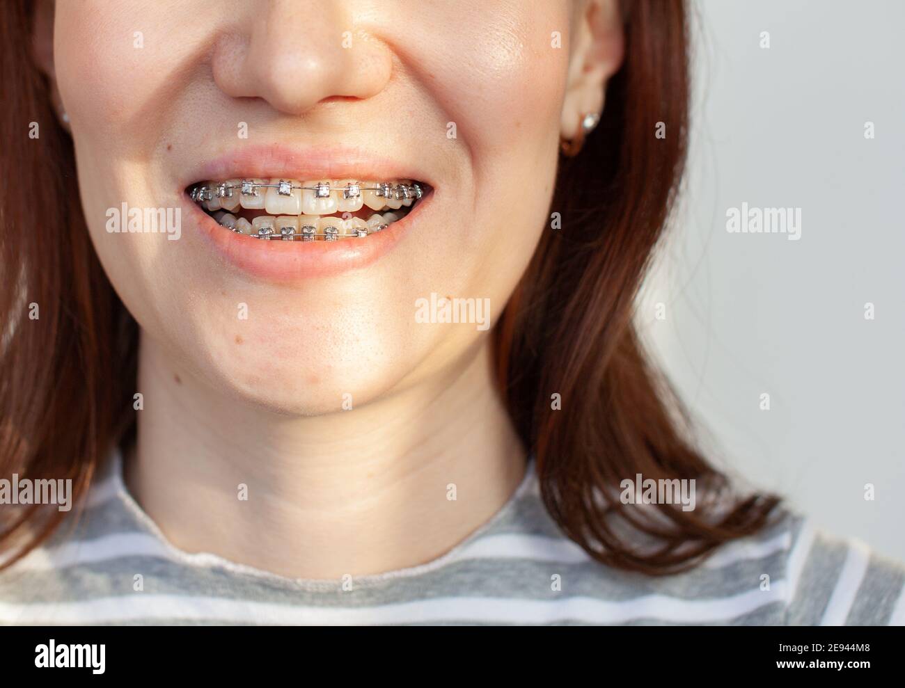 283 Braces Rubber Bands Stock Photos - Free & Royalty-Free Stock