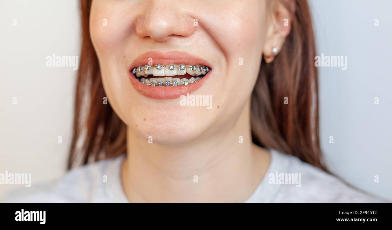 Braces in the smiling mouth of a girl. Closeup photos of teeth and