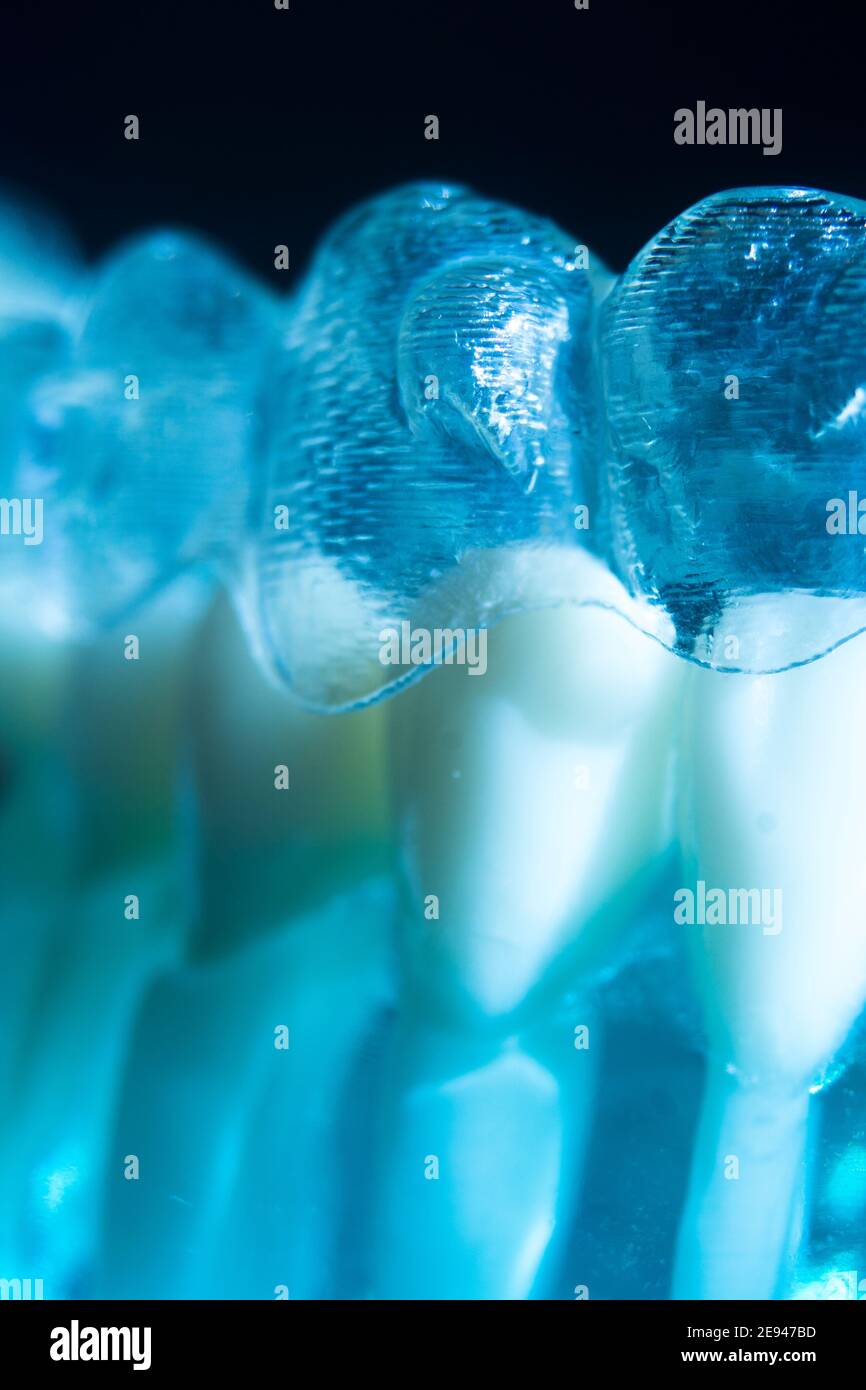 Modern invisible brackets aligner straighterners used to correct