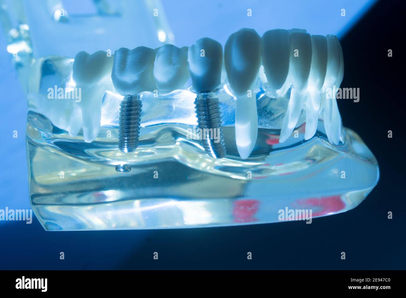 Dental tooth metal implant dentistry teaching model showing teeth and