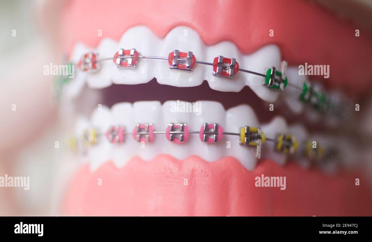 Dental teeth aligner bracket teaching student model showing gums and