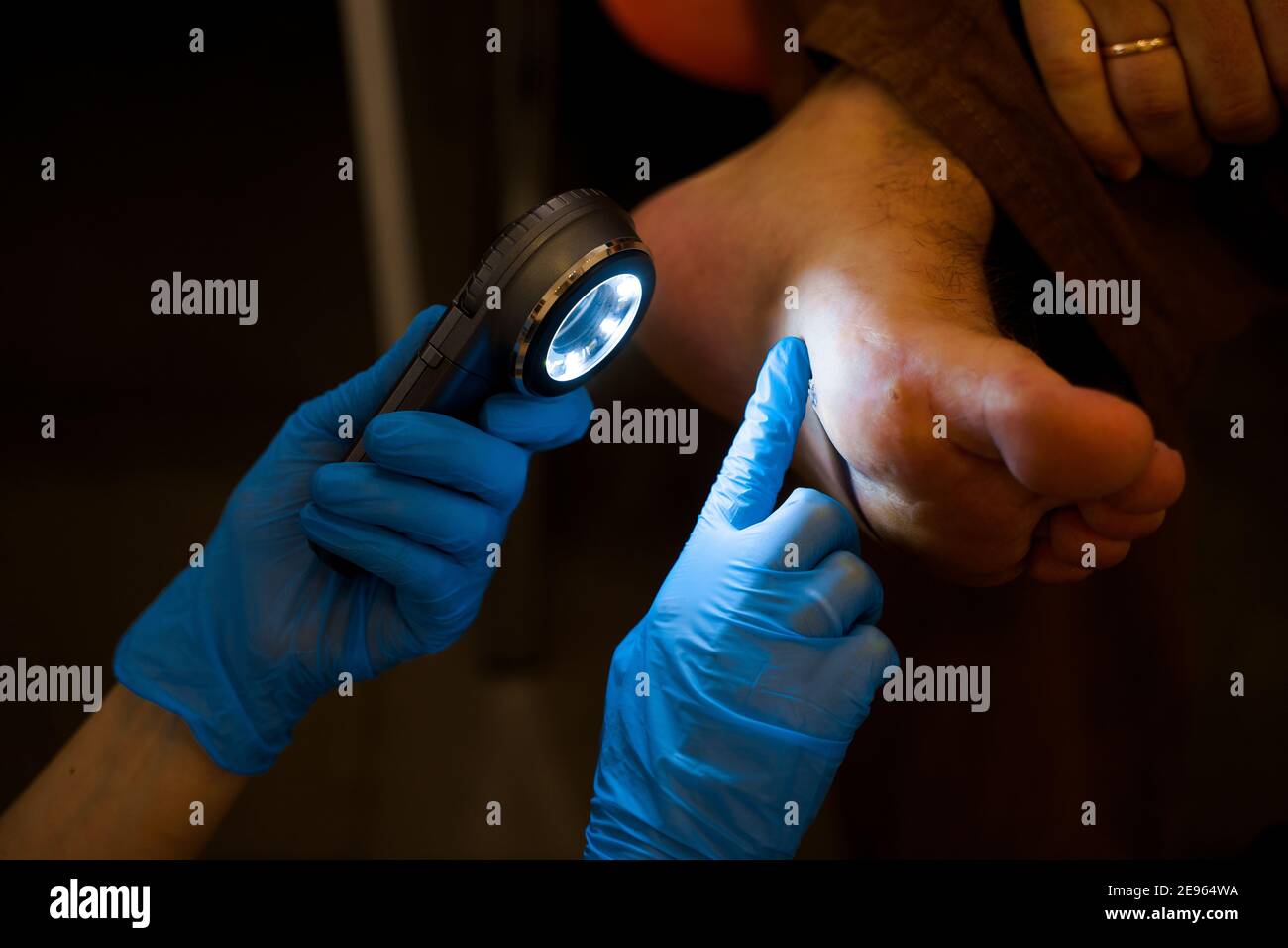 Laser removal of warts on the foot. Medical dermatological surgery in