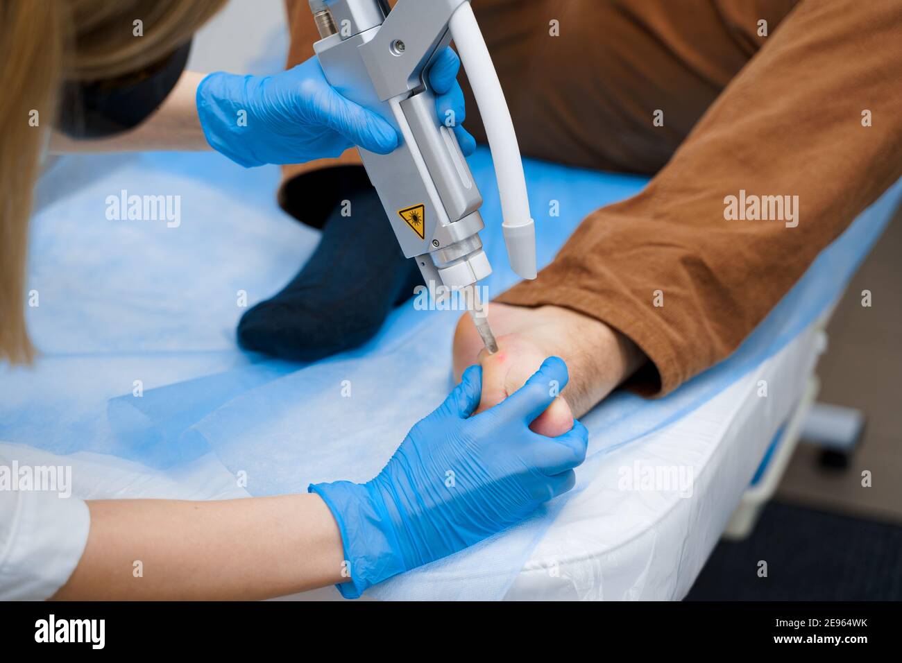 Laser removal of warts on the foot. Medical dermatological surgery in
