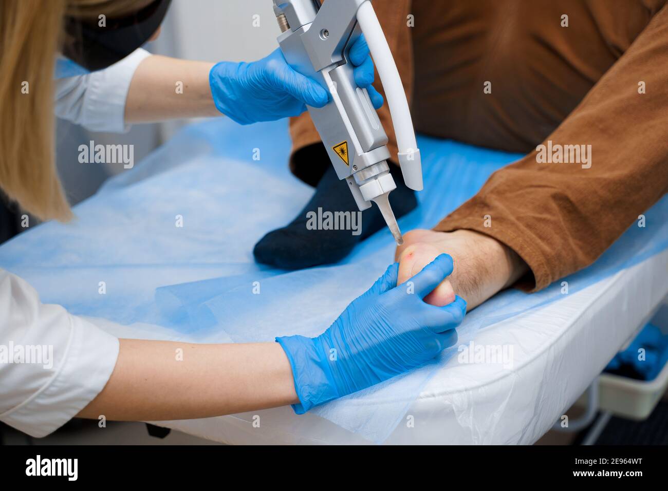 Laser removal of warts on the foot. Medical dermatological surgery in the clinic Stock Photo Alamy
