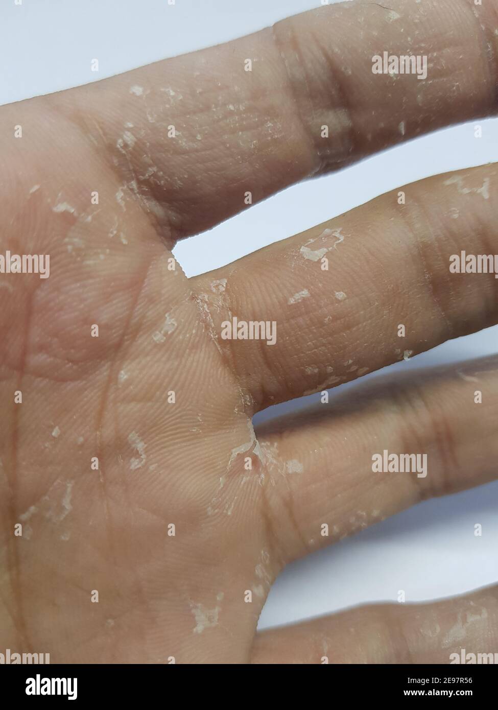 Skin peeling on palm(skin disease) Stock Photo