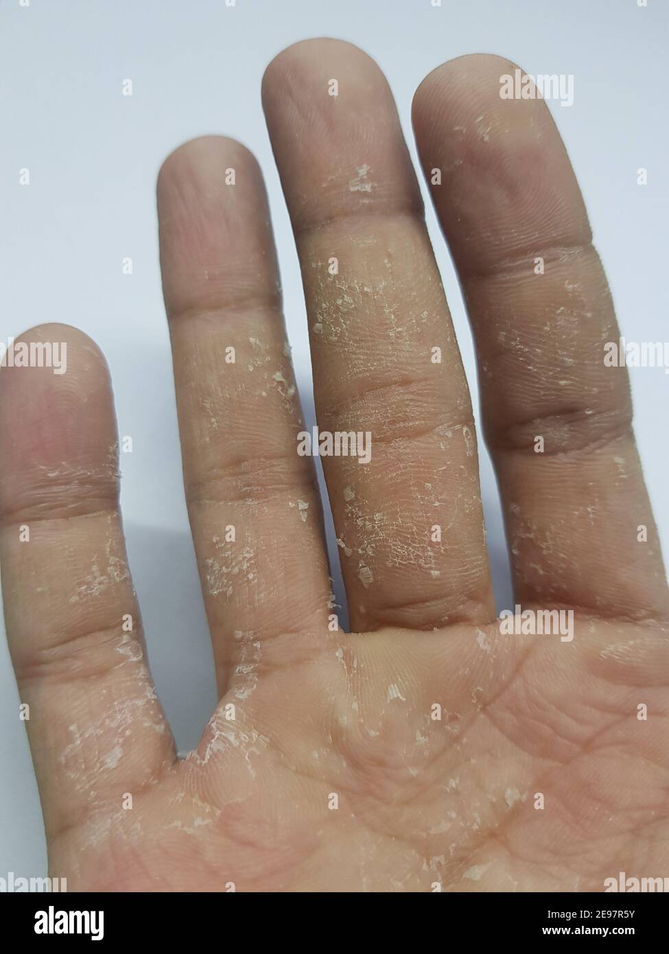 Skin peeling on palm(skin disease Stock Photo - Alamy