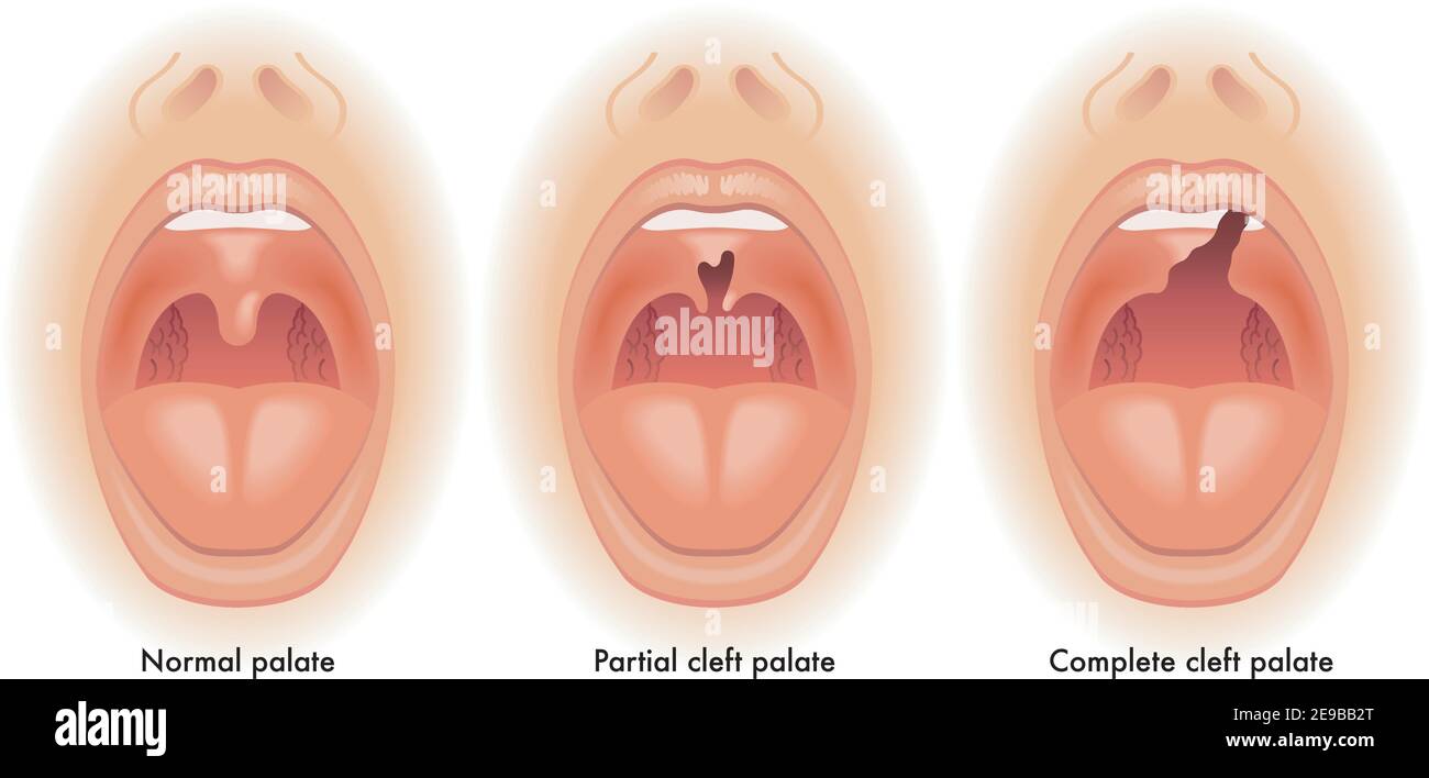 Cleft palate hires stock photography and images Alamy