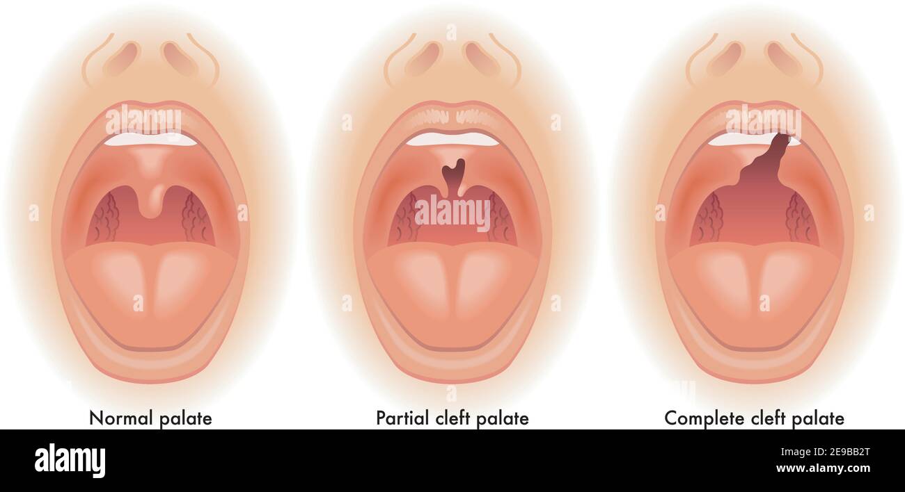 Medical illustration shows the difference between a normal palate, a partial cleft palate, and a complete cleft palate, with annotations. Stock Vector