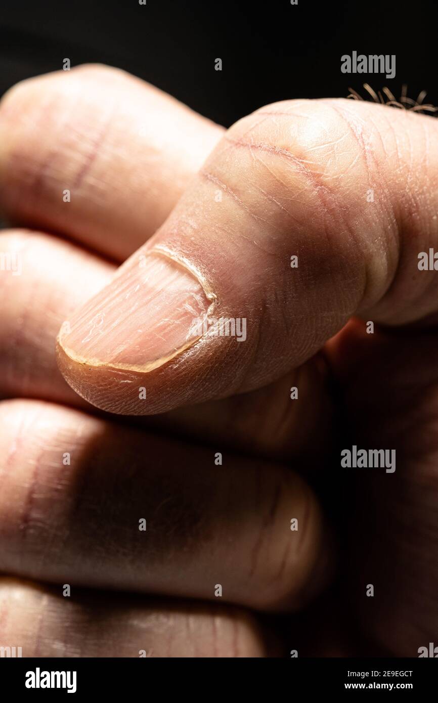 Discover 147+ nail bed images noithatsi.vn