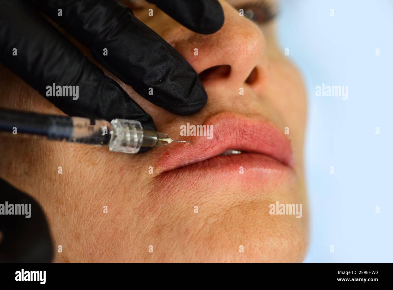 Procedure augmentation. Syringe hyaluronic acid injection, augmentation